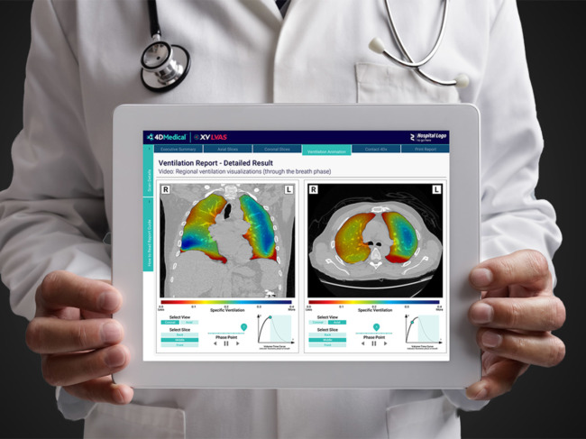 4dmedical’s-Lung-Ventilation-Analysis-Software-(XV-LVAS)-reveals-detailed-maps-of-the-patterns-of-lung-motion-and-pulmonary-function2.jpg