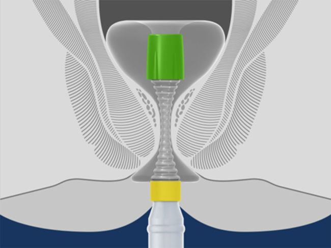 Hygh-tec-transanal-sealing.jpg