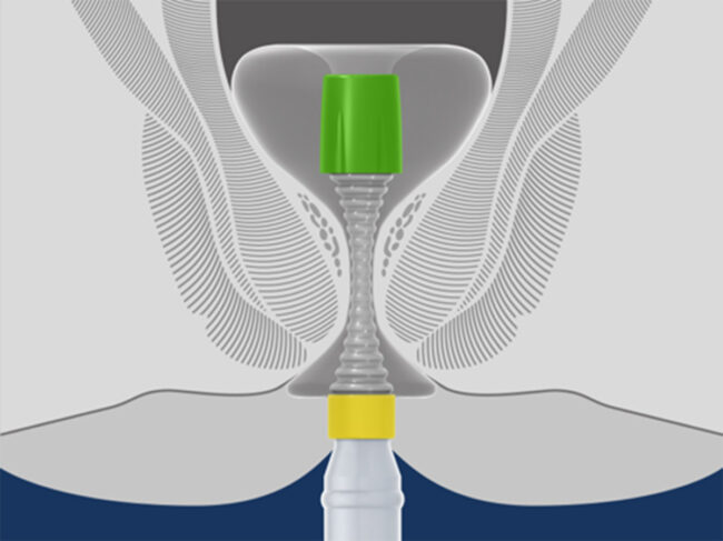 Hygh-tec-transanal-sealing.jpg