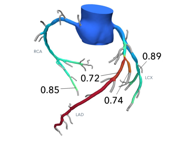 Digital 3d heart model showing FFR values along coronary arteries