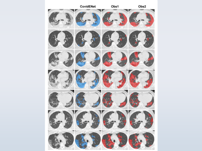 Software analysis of chest CT scans