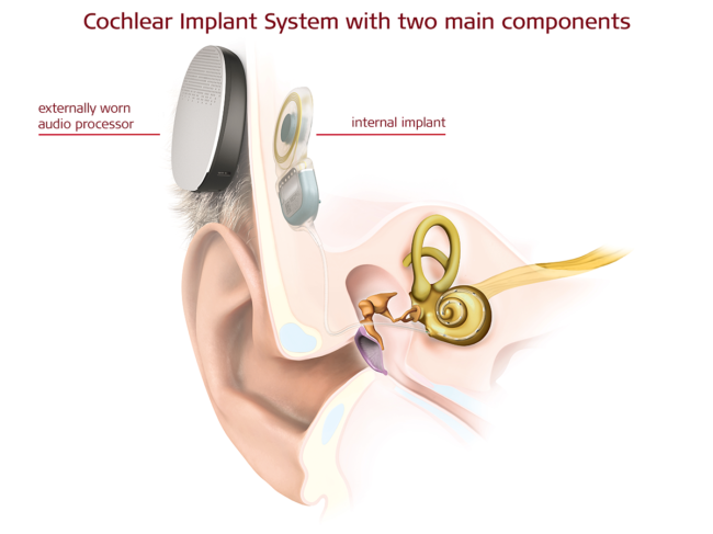 Illustration of ear anatomy, traditional cochlear implant