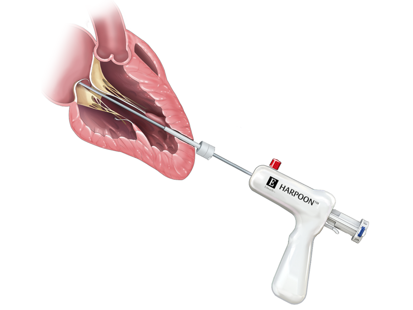 Edwards Lifesciences launches pivotal trial of mitral