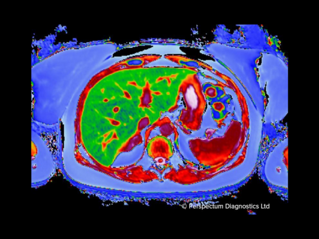 4-23-Perspectum-livermultiscan.png