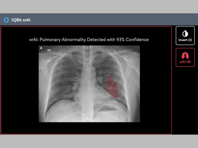 1QBit-xrAI-Chest-X-ray-Abnormal.png