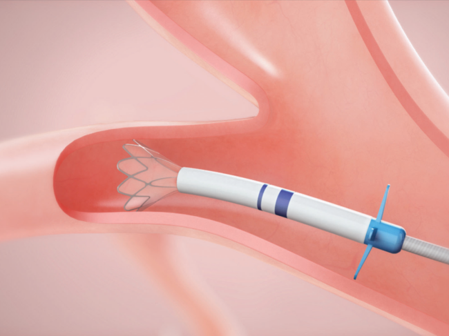 Illustration of Zephyr valve deployment in lung