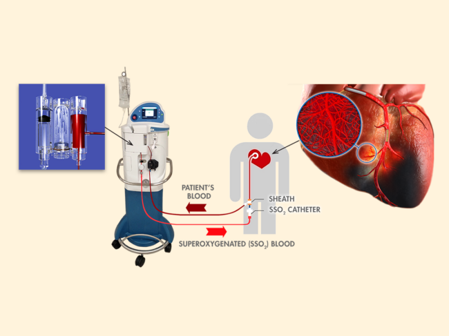 Diagram of SSO2 use for heart