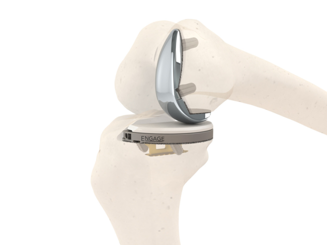 Knee implant in skeleton model