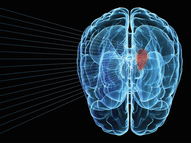 Brain tumor illustration