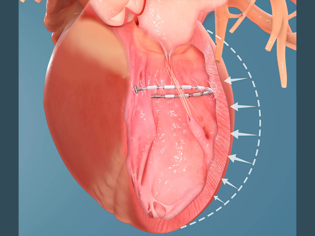 Accucinch in heart illustration