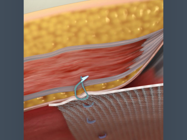 Illustration of Fastouch being used to fasten mesh to the abdominal wall