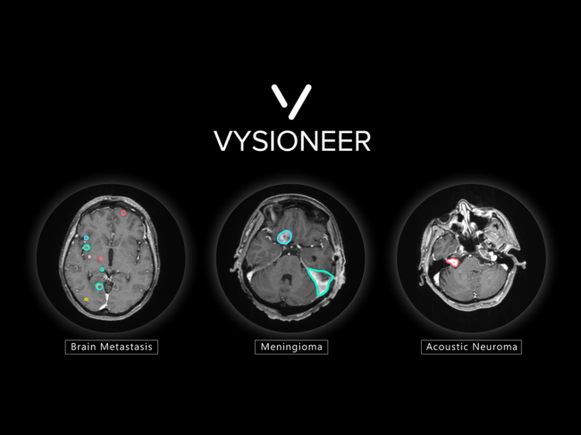 Brain scan images with tumors edged out by AI