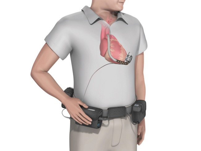 3D rendering of man wearing HVAD on heart