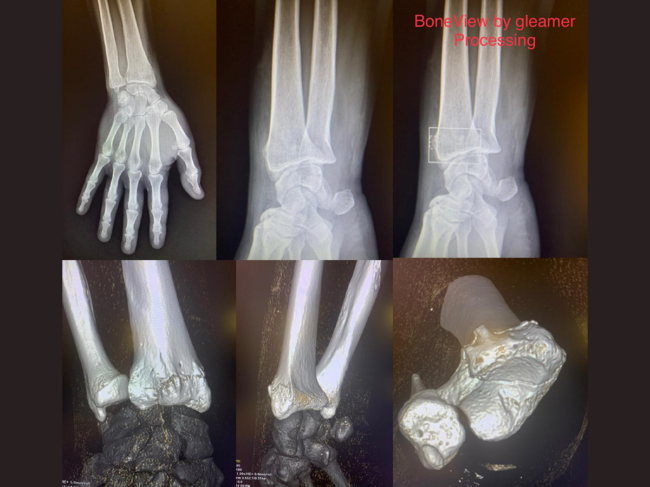 X-ray bone images from Boneview software