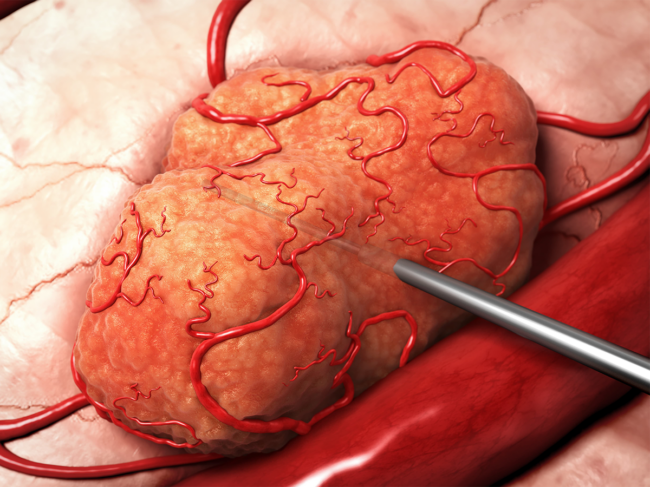 Illustration of DART being inserted into tumor