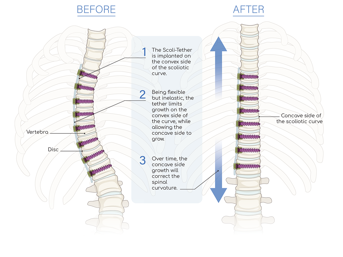 Why Does Scoliosis Get Worse With Growth? Scoliosis Care, 55% OFF