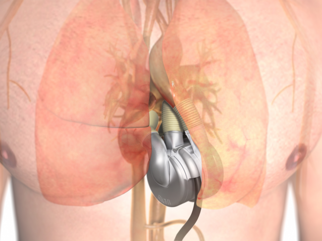 3D illustration of Bivacor implanted in chest