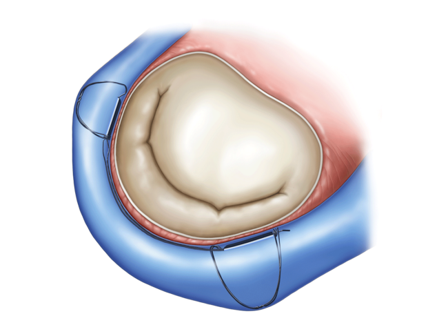 Illustration of Carillon in mitral valve