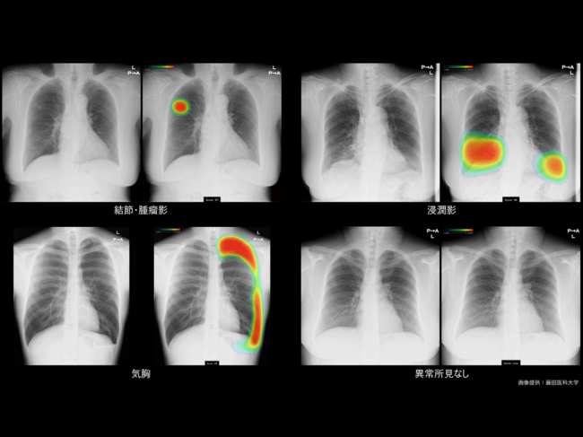 Chest X-ray analyzed using CXR-AID