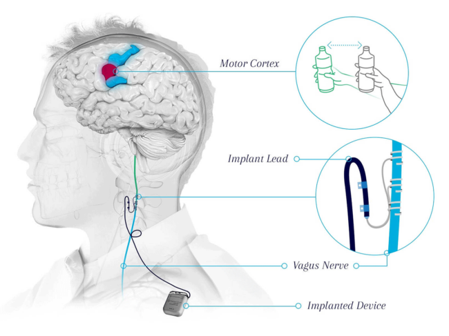 Diagram showing how Vivistim works