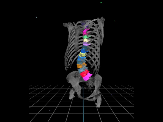 A model of a 3D segmented scoliosis spine 