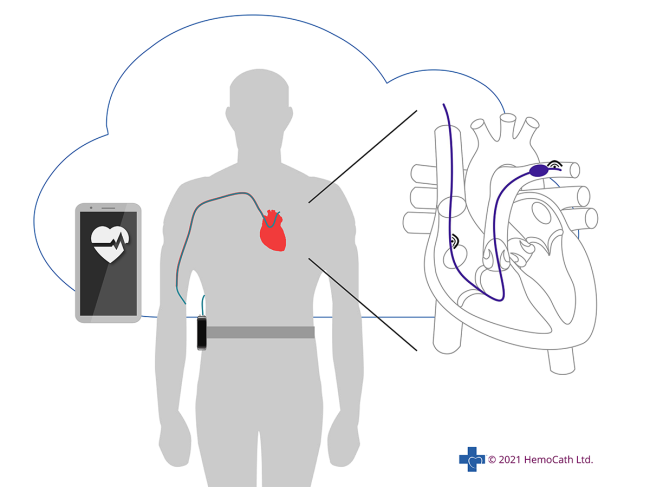 Diagram of Hemocath intelligent HF monitoring platform