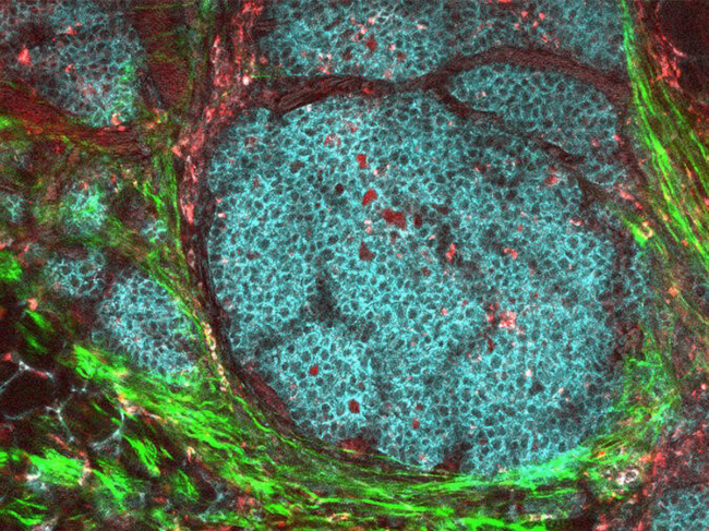 Tumor microenvironment image obtained using multiphoton microscopy and endogenous fluorescence