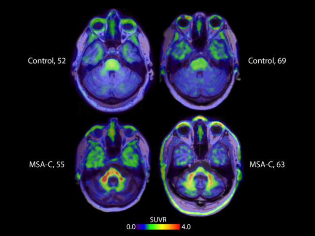 PET images of brains showing alpha-synuclein