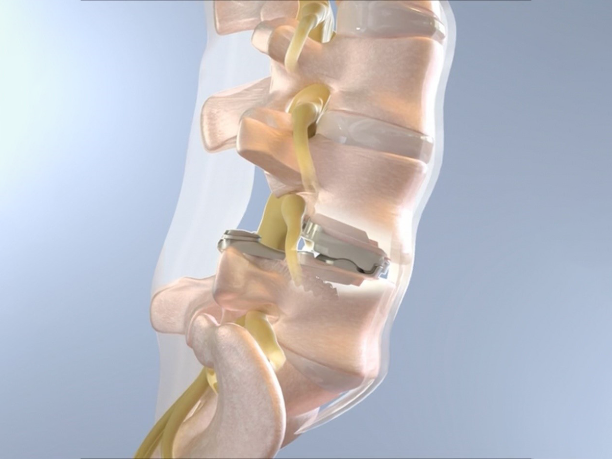 3Spine raises $33M to advance first total joint replacement for