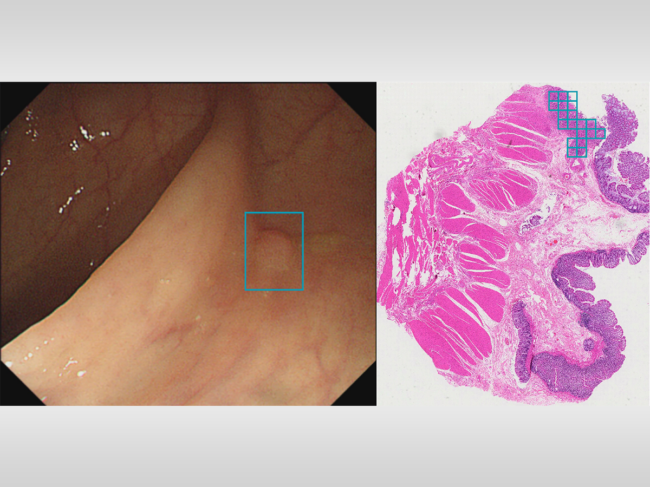 AI detection of colorectal cancer in endoscopy, histopathology