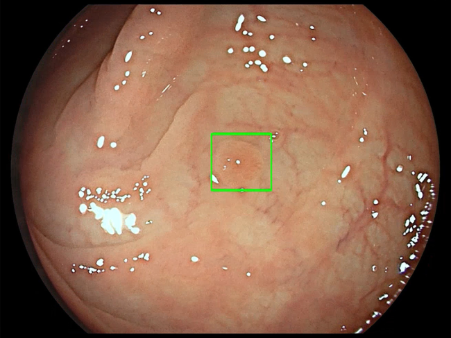 Image from GI Genius intelligent endoscopy module