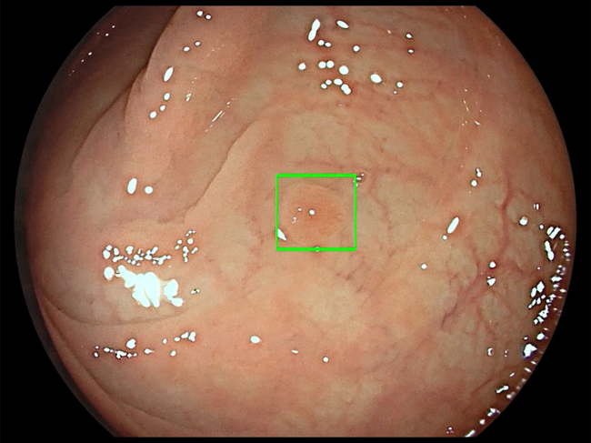 Image from GI Genius intelligent endoscopy module