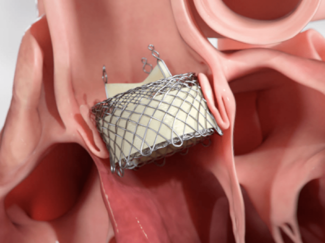 Meridian TAVR device in heart model