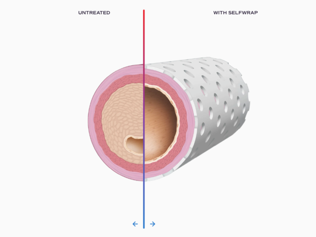 Illustration of untreated vein (left) vs. vein with Shelfwrap (right)