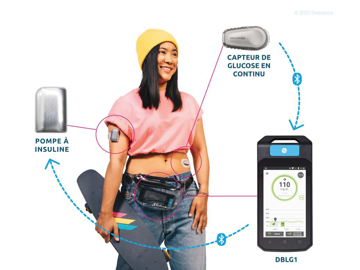 diabeloop dexcom