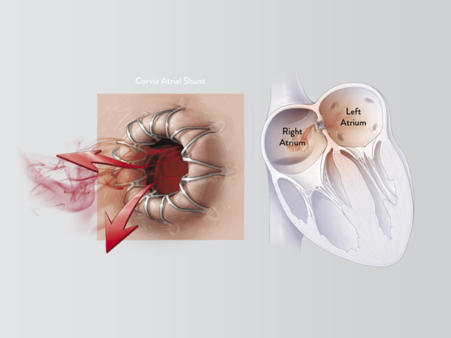 Illustration of Corvia atrial shunt in heart