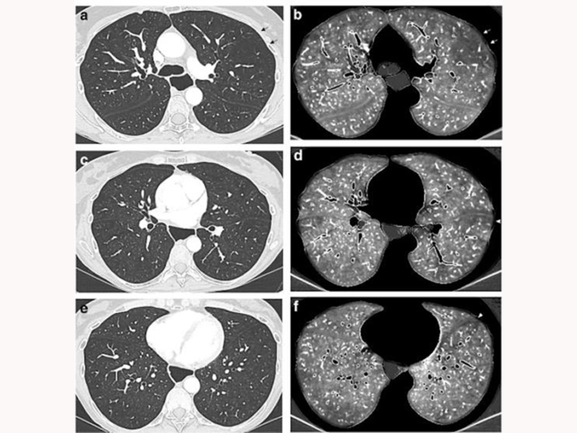 Dual energy CT angiographic examination obtained in a 55 year old