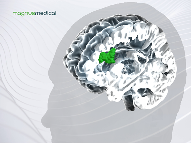 Saint Neuromodulation System - Magnus Medical