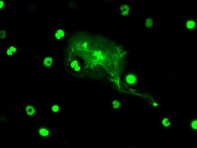 A neutrophil undergoes NETosis