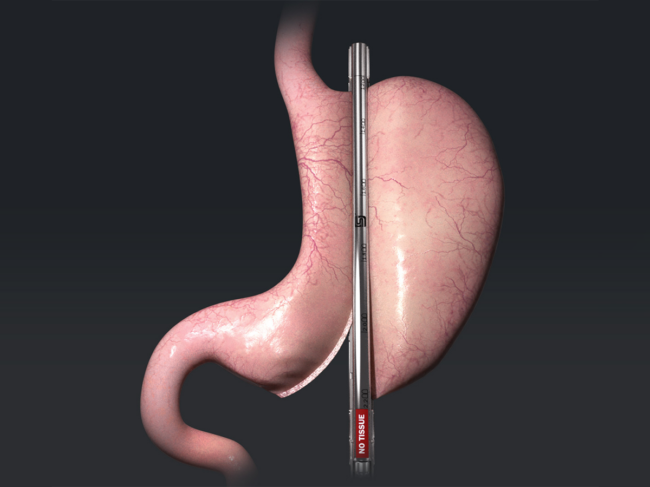 Illustration of Titan SGS on stomach