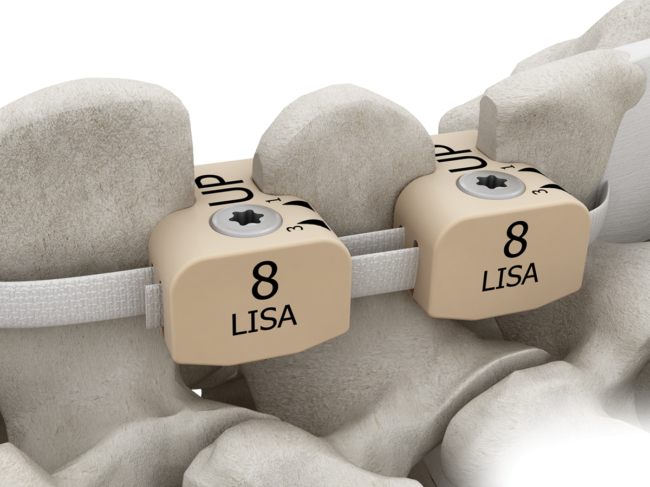 Lisa implant - Backbone SAS