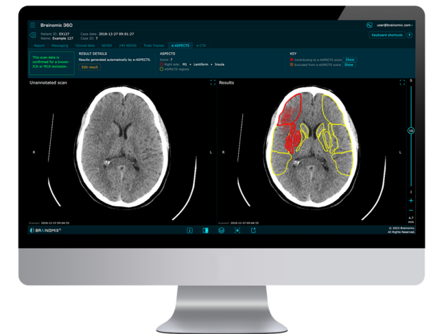 Brainomix - 360 E aspects software