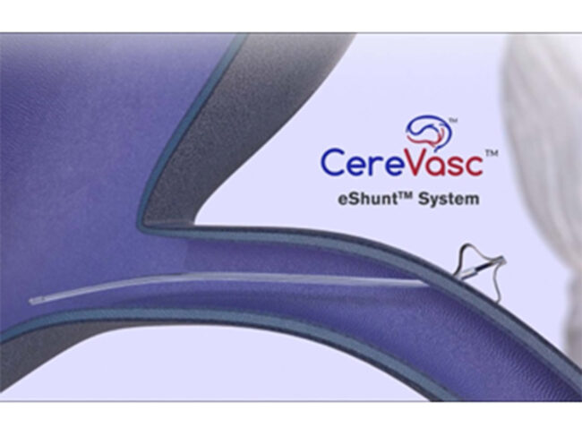 Cerevasc Inc.'s eshunt system