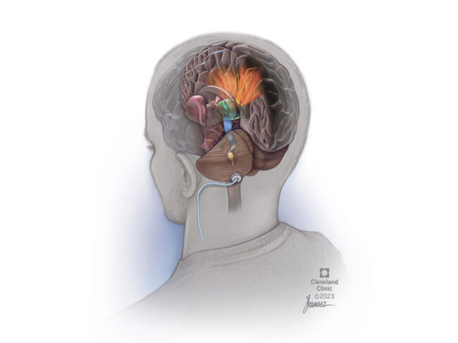 DBS for stroke 