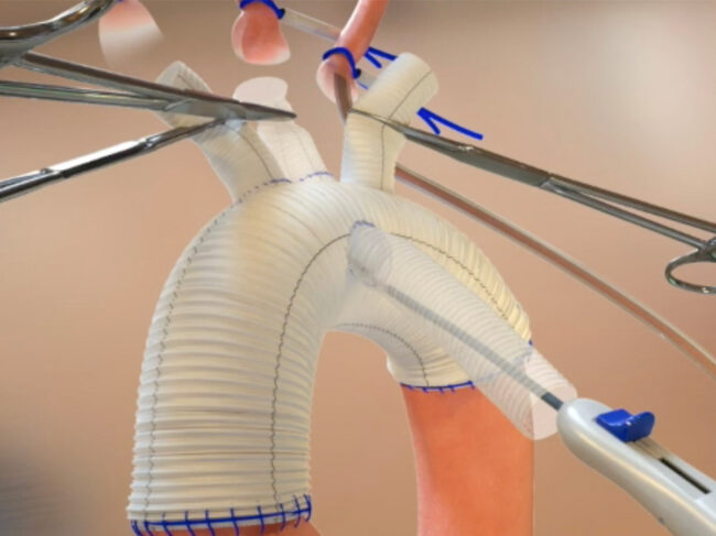 Duett Vascular Graph System