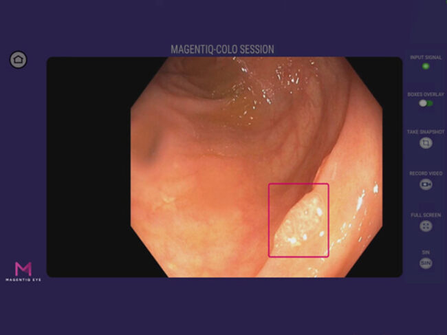 Magentiq Eye Colonoscopy imaging