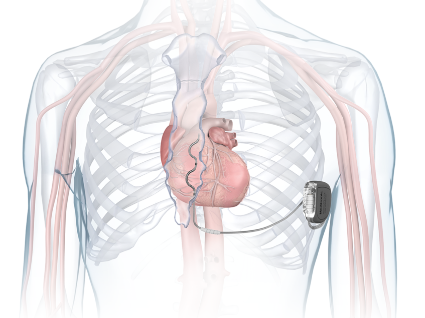 Medtronic CE mark receipt strengthens cardiac rhythm business | BioWorld