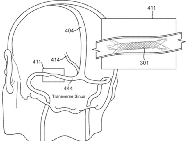 Sonorous braided stents