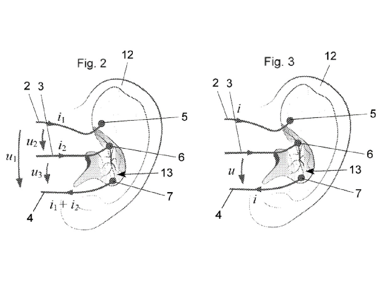 Vagus Nerve Stimulation Device