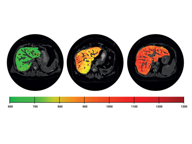 Perspectum Livermultiscan